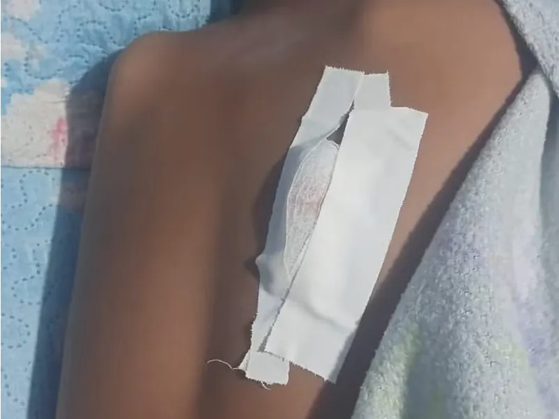 Acidente com vergalhão causa ferimento grave em criança em Soure-PA